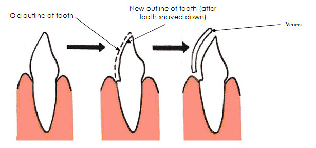 tooth veneers
