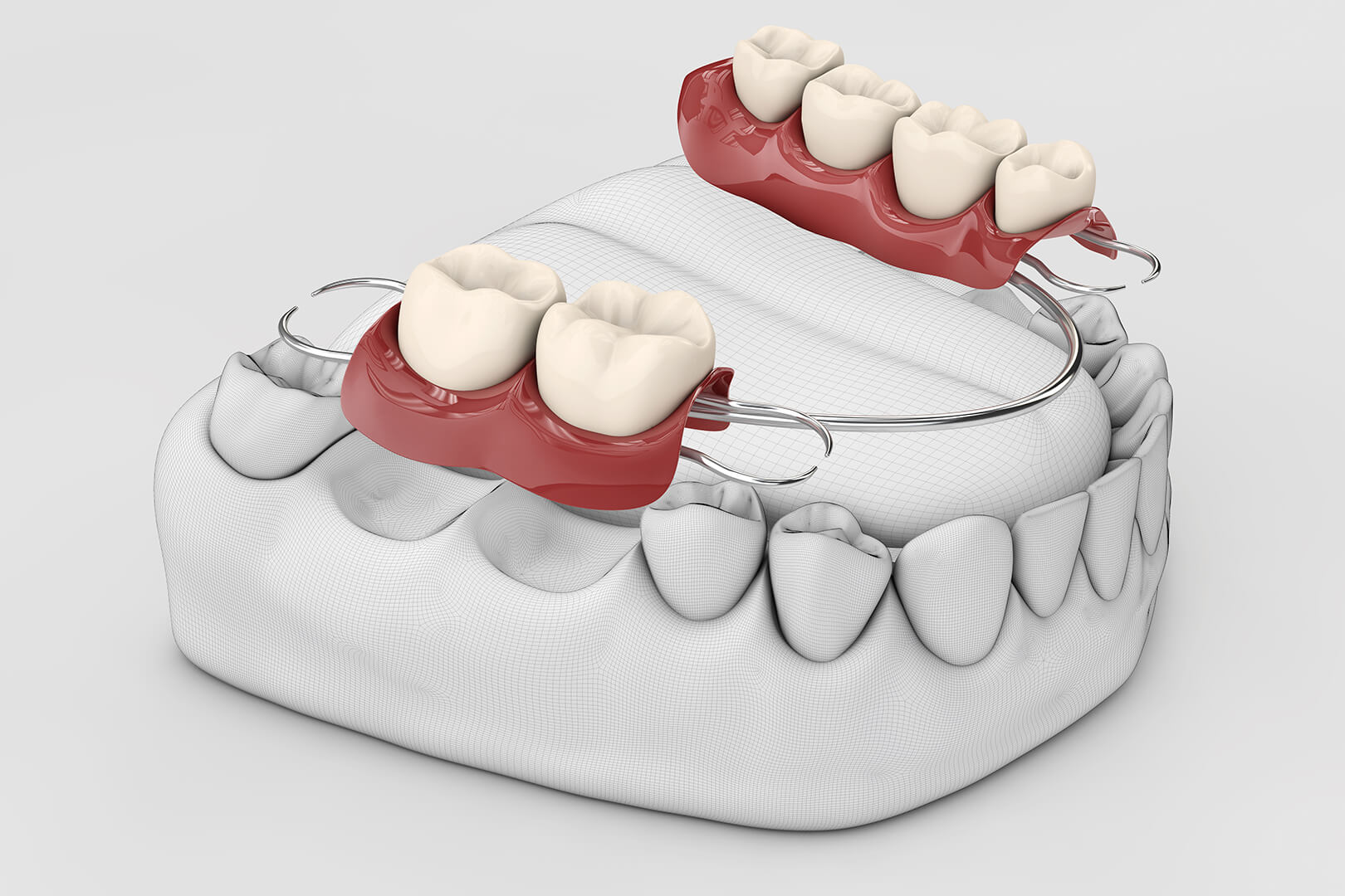Prosthodontist Services in Forest Hills, Queens 1 mainbridges Prosthodontist Services in Forest Hills, Queens