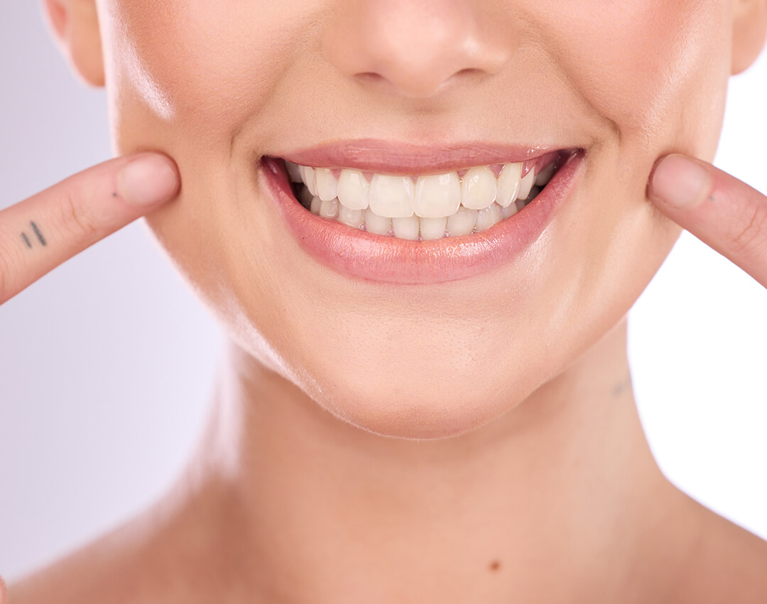 Veneers Madison Dental Art