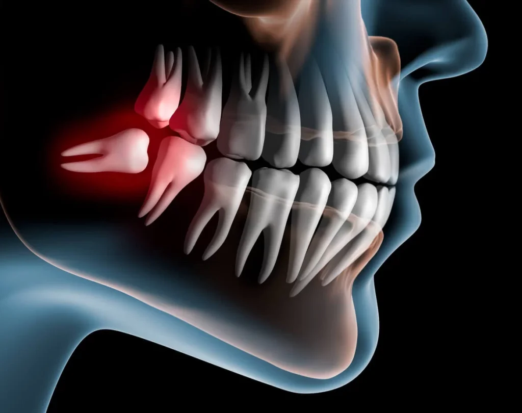 Why Do I Need My Wisdom Teeth Removed Why Do I Need My Wisdom Teeth Removed?