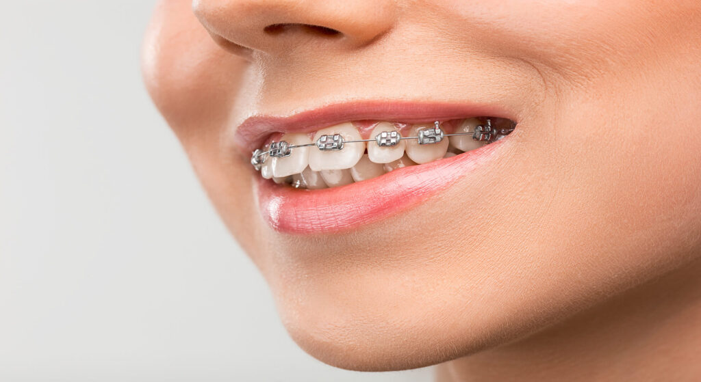 type braces Types of Braces and Innovations