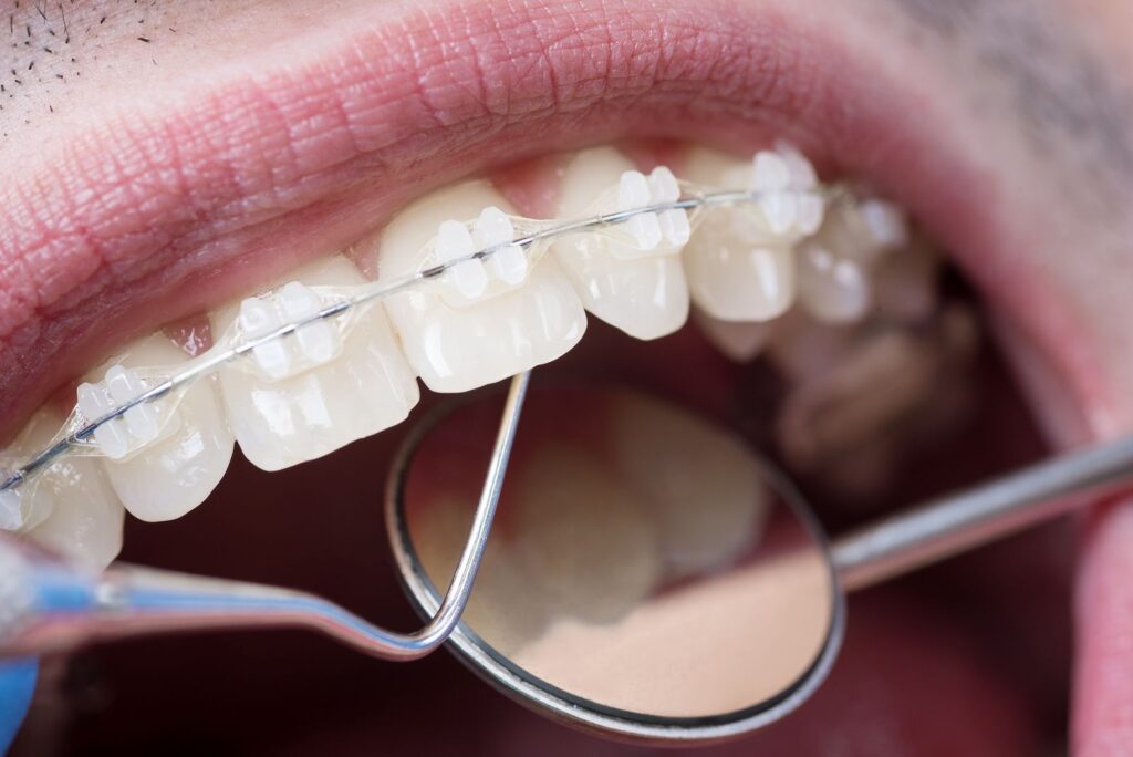 Can You Wear Braces with Crowns What You Need to Know Can You Wear Braces with Crowns? What You Need to Know