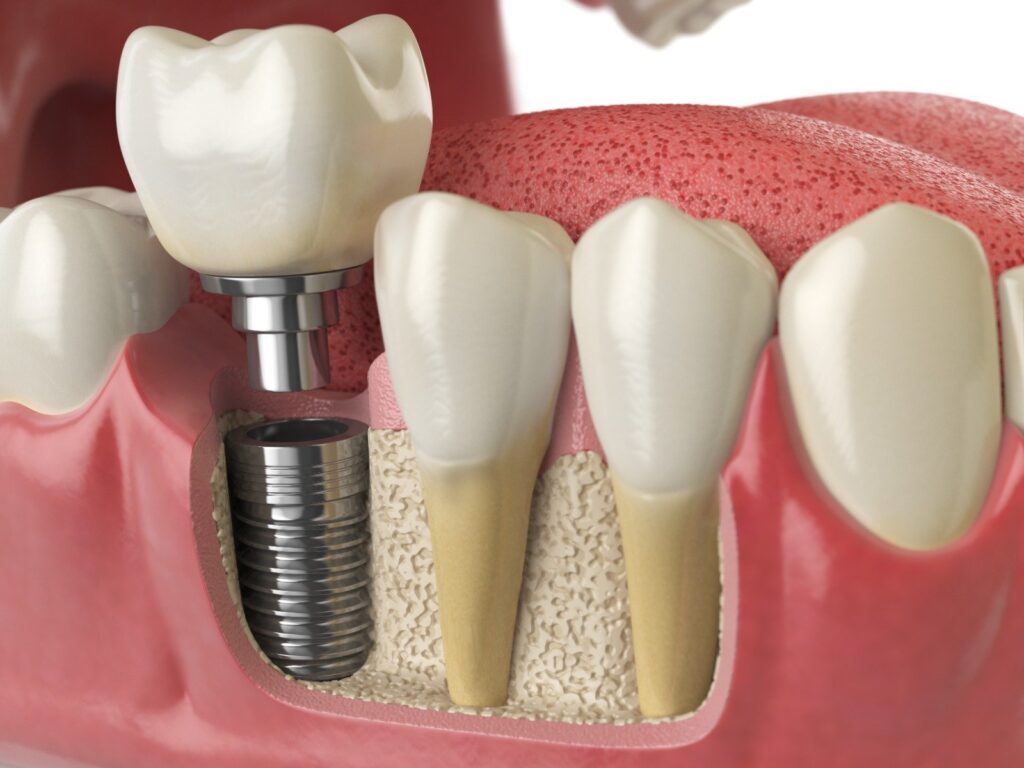 Dental Implants Healing Time Strength and Long Term Benefits Dental Implants: Healing Time, Strength, and Long-Term Benefits