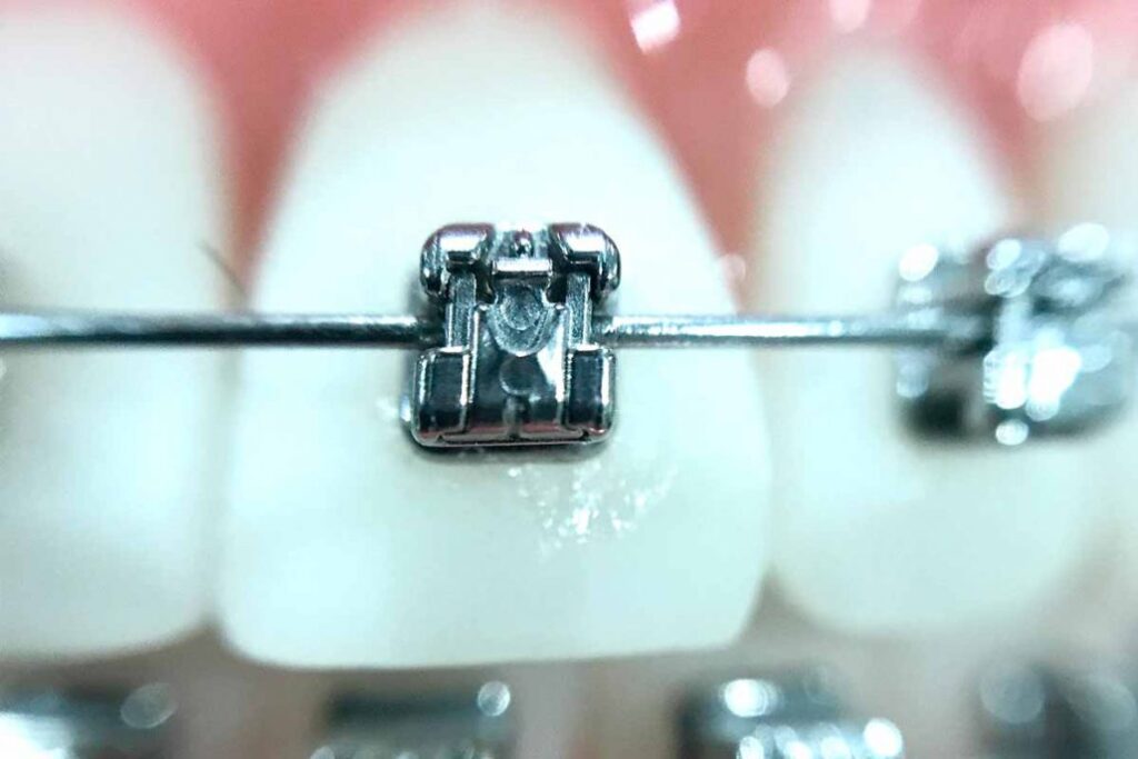 What Braces Are Made Of Materials and Metals What Braces Are Made Of: Materials and Metals