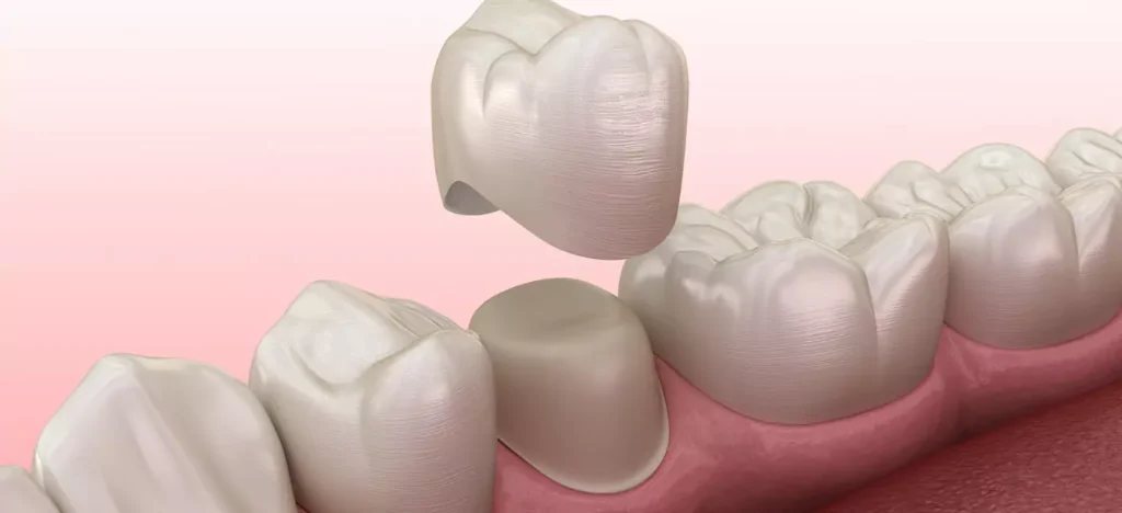 What Is a Dental Crown Everything You Need to Know What Is a Dental Crown? Everything You Need to Know