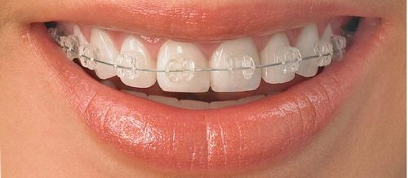 Close-up of a smiling person with clear braces for discreet orthodontic treatment.