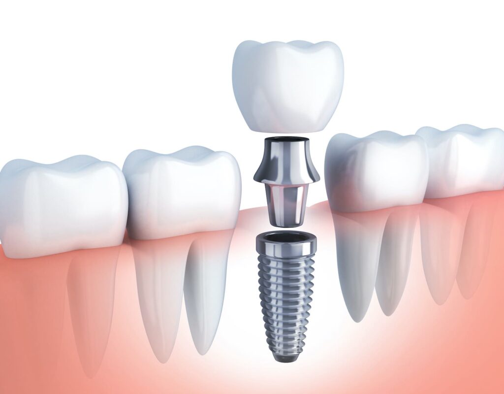 Are Titanium Dental Implants Safe What You Need to Know Are Titanium Dental Implants Safe? What You Need to Know