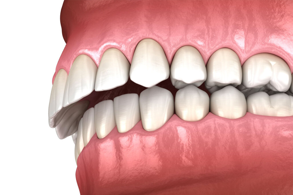 Do You Need Braces for an Overbite Treatment Options Explained Do You Need Braces for an Overbite? Treatment Options Explained