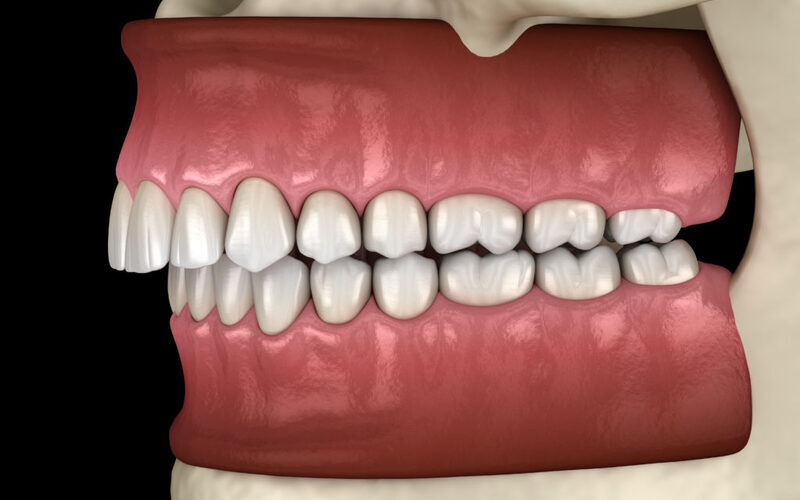 How Do Orthodontists Fix Overbites Treatments Timeline What to How Do Orthodontists Fix Overbites? Treatments, Timeline & What to Expect