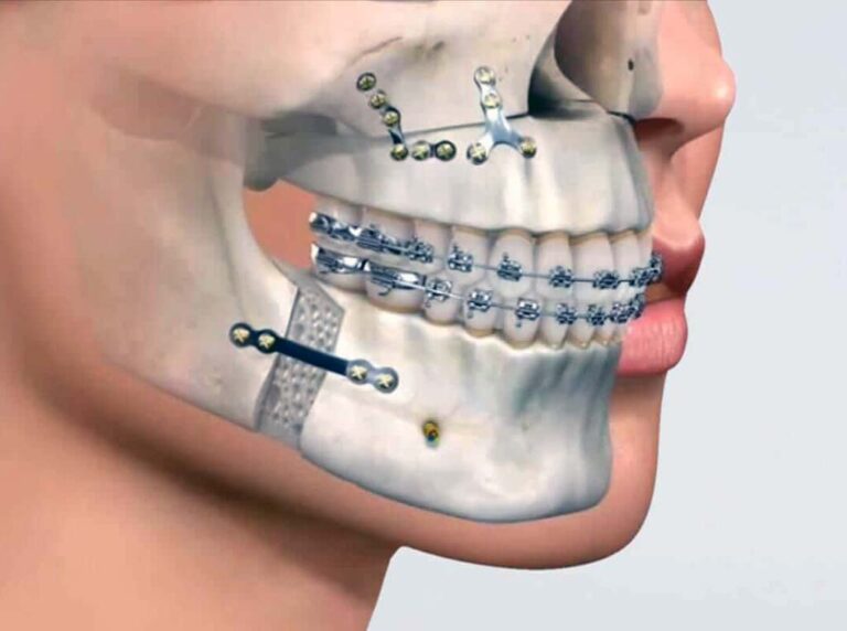 Jaw Surgery for Overbite: Procedure, Recovery & When It’s Needed ...