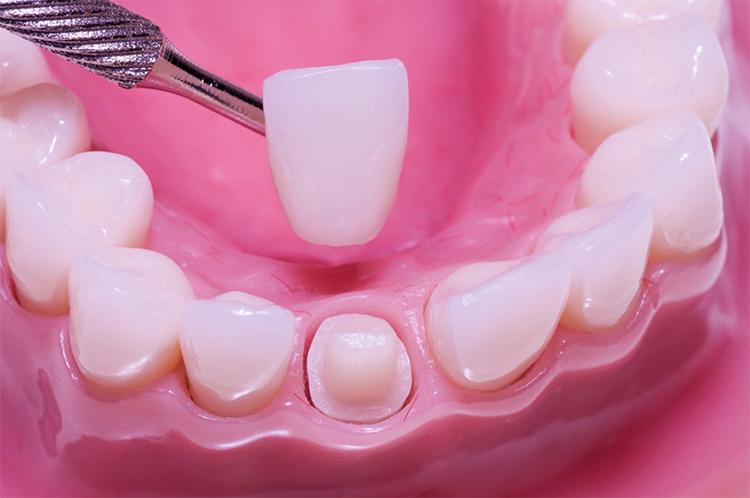 Does Dental Insurance Cover Crowns? 1 Does Dental Insurance Cover Crowns Does Dental Insurance Cover Crowns?