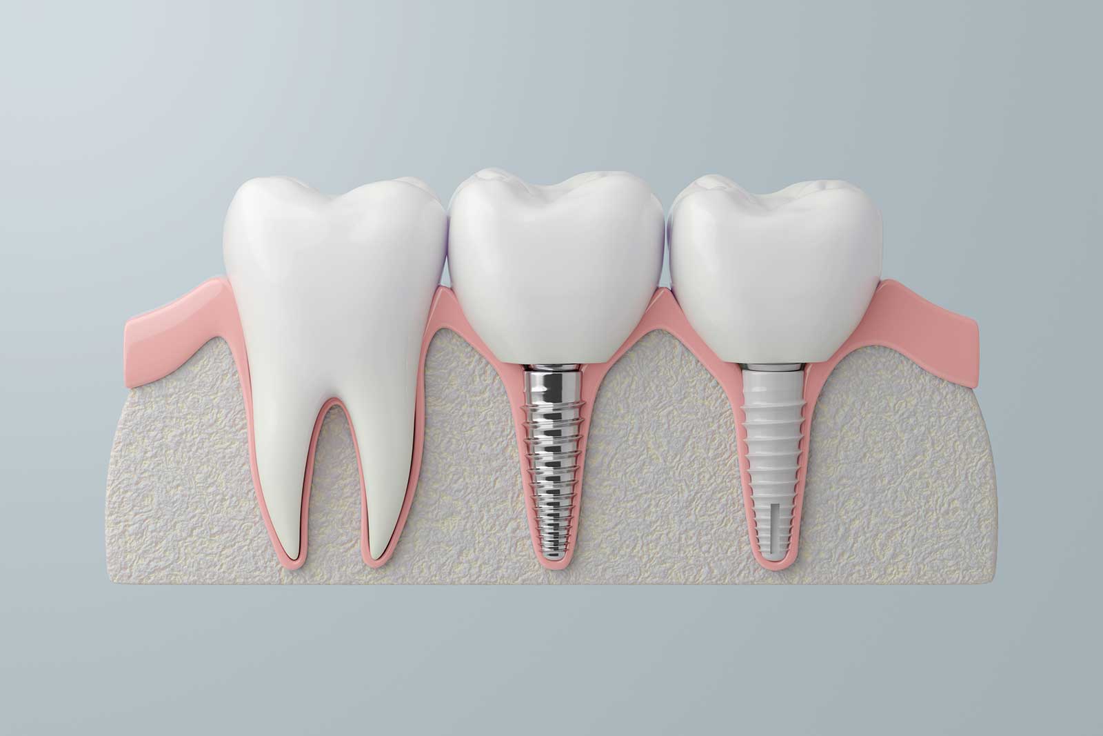 How Much Does a Full Set of Dental Implants Cost? 1 How Much Does a Full Set of Dental Implants Cost How Much Does a Full Set of Dental Implants Cost?