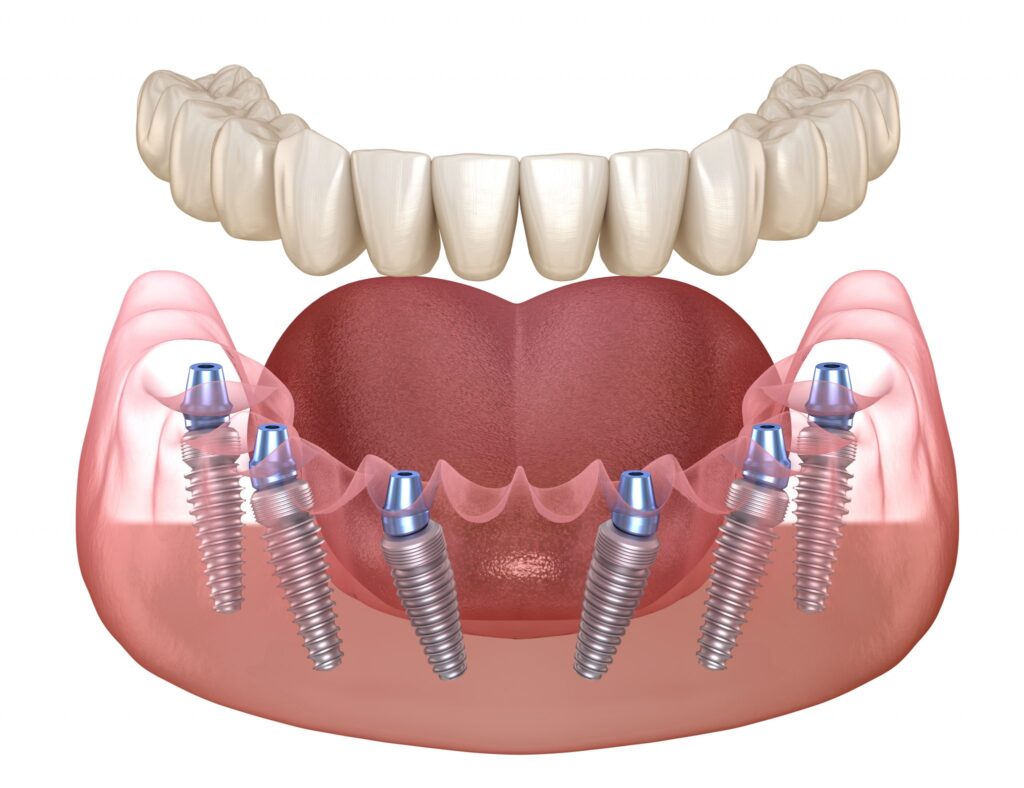 How Safe Are Dental Implants? 1 How Safe Are Dental Implants How Safe Are Dental Implants?