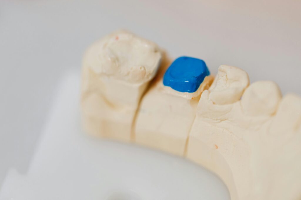 Dental Crown Issues Dental Crown Issues: Pain, Cracks, and Sensitivity