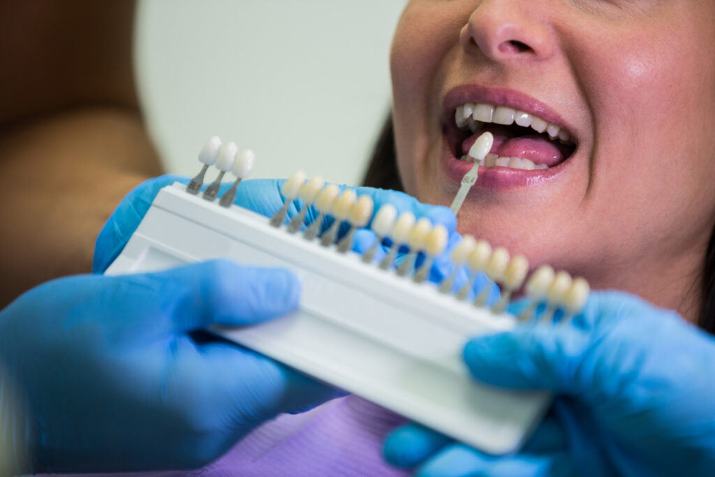 Can Dental Bonding Be Whitened What You Should Know Can Dental Bonding Be Whitened? What You Should Know