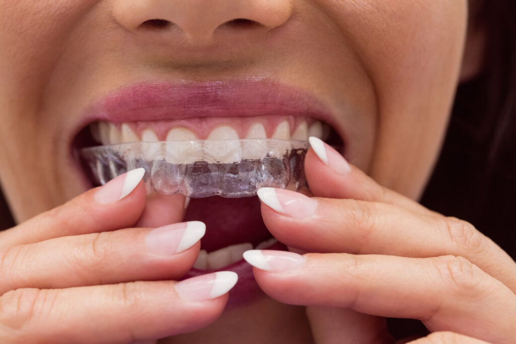 Should You Wear Night Guard on Upper or Lower Teeth? 1 Should You Wear Night Guard on Upper or Lower Teeth Should You Wear Night Guard on Upper or Lower Teeth?
