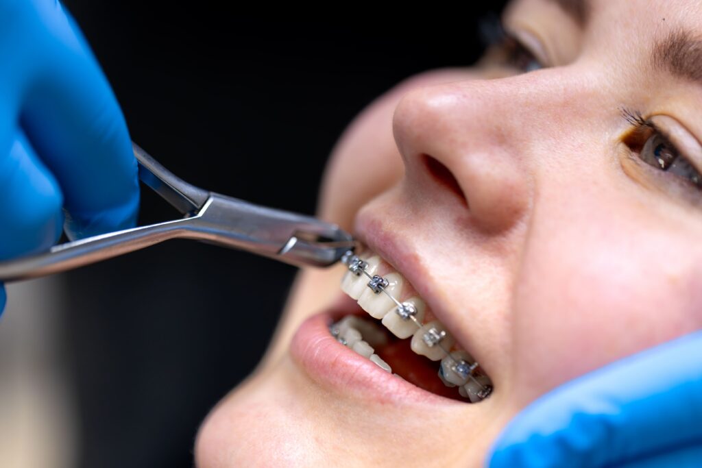 Braces 8 dental procedure installing braces close up dentistry braces teeth 1 Braces