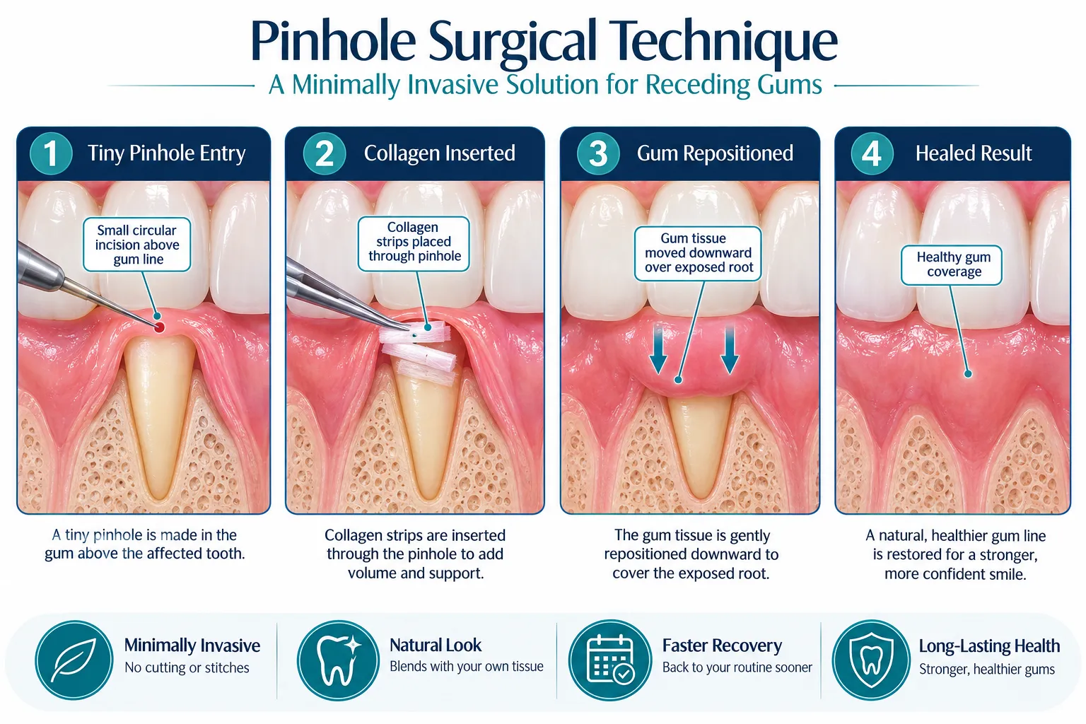 Pinhole Surgery Price: What NYC Patients Need to Know 2 What Is Pinhole Surgery and Why Does It Matter