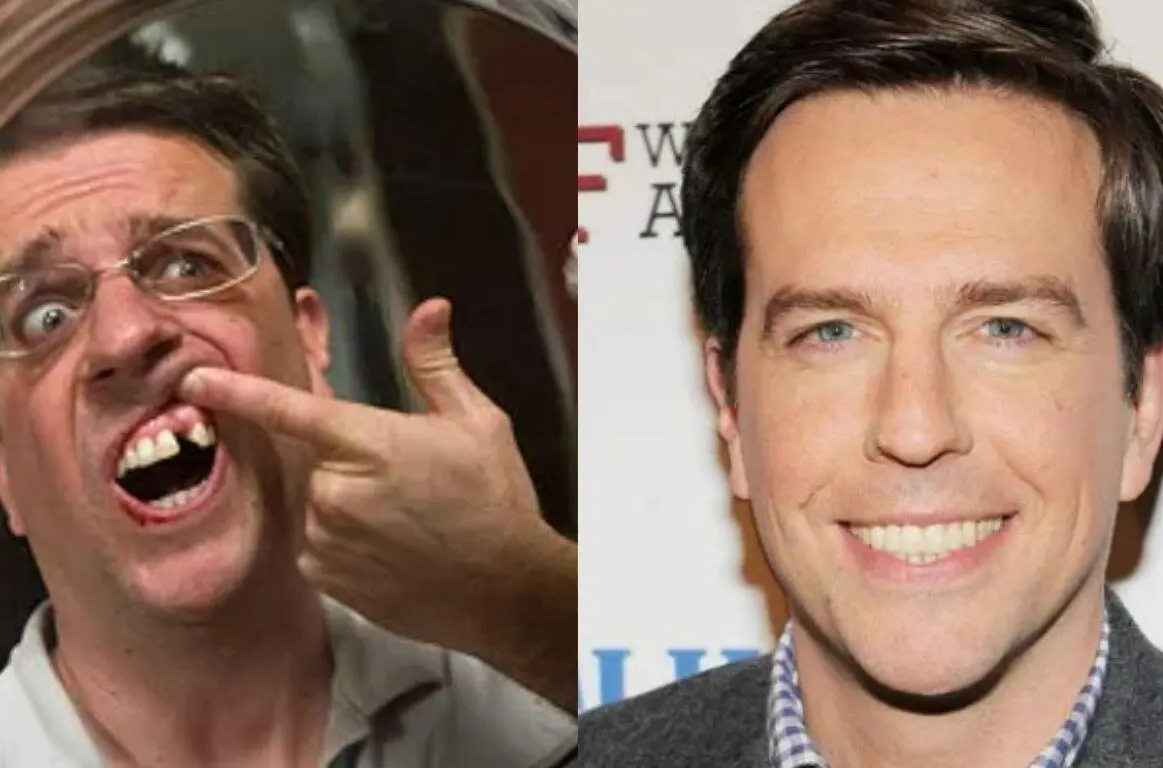 image 2 edited Permanent Dentures Celebrity Dental Implants Before and After: What Their Smile Transformations Reveal