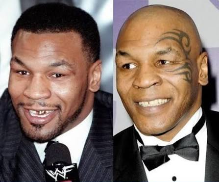 image edited Permanent Dentures Celebrity Dental Implants Before and After: What Their Smile Transformations Reveal
